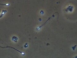 Human sperm with two tails swimming ineffectually Stock Footage