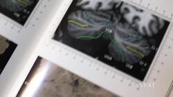 The man with the famous brain News Clip