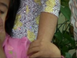 Vietnamese girl with 16-pound facial tumour awaits surgery News Clip