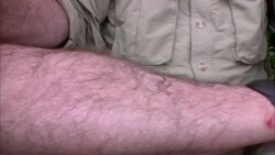 A man sits quietly with a swollen leech attached to his hairy leg. Stock Footage