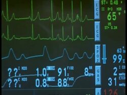 CU Heart monitor showing uneven pressure Stock Footage
