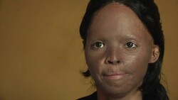 Acid attacks - surviving and fighting back News Clip