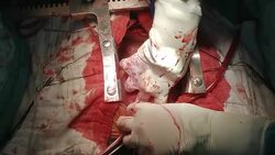 Surgeon apply Aortic cross clamp Stock Footage