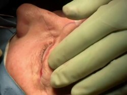 Facelift operation, clip 24 of 24. The surgeon has removed a flap of skin from the eyelid and is now sewing the two edges together, which will give a tighter appearance. This is the blepharoplasty stage of the operation Stock Footage