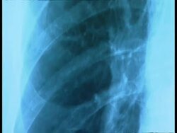CU Tilt up, X-ray photo of chest Stock Footage