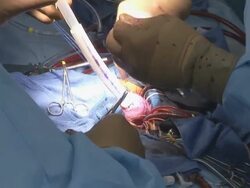 CU ZI  Doctors operating on childs heart surgery  /  Little Rock, Arkansas, USA Stock Footage