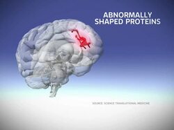 Possible breakthrough in Alzheimer's treatment News Clip