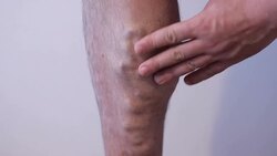 varicose veins Stock Footage
