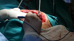 Close up view of open heart surgery Stock Footage