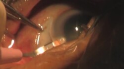 step 3. Surgery Cataract. Category-A Stock Footage