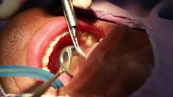dental implant. Stock Footage