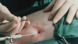 MONTAGE Doctor making incision on patient during surgical procedure / United Kingdom Stock Footage