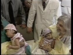 Guatemalan former conjoined twins celebrate 2nd birthday Instructional Video