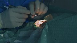 Microsurgery. Injection at eyeball Stock Footage