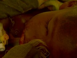 Sick child asleep at refugee hospital Stock Footage