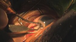 step 6. Surgery Cataract Eye. Category-A(clip 2) Stock Footage