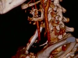 CU TD TU CT scan of human skull / Vermont, USA Stock Footage