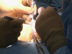 MS ZI  Doctors operating on chest surgery  /  Little Rock, Arkansas, USA Stock Footage