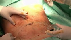 VOICED: Europeans flock to Morocco for cheaper plastic surgery News Clip