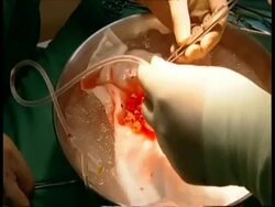 CU Surgeon's hands preparing organ for transplant Stock Footage