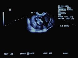 NTSC: Baby Ultrasound Stock Footage