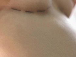 HD: Breast And Abdomen Cosmetic Surgery Stock Footage