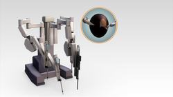 Indian hospital begins using popular surgery robot system Instructional Video
