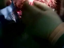 Facelift operation, clip 15 of 24. Th surgeon is using a stapler to close the incisions made in the patient's scalp. The incisions were made so that screws could be inserted into the skull, to which sutures were attached that hold the skin Stock Footage