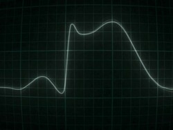 EcG_HeartAttackInTimeOverLapConvex Stock Footage