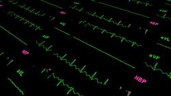 ECG Stock Footage