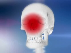 HD: Human Skull Indicating Rhinitis Stock Footage