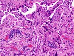 Microscopic image of human lung cancer cells Stock Footage