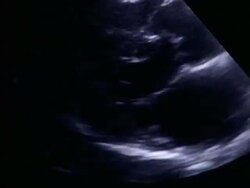 CU Echocardiogram ultrasound of heart beating on computer / Vermont, USA Stock Footage