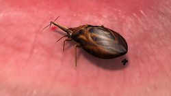 Chagas disease posts lifelong threat of heart failure Instructional Video