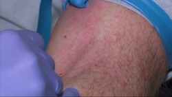IV Bars Inject Debate into Medical Spa Market Instructional Video