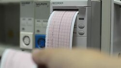 ECG Stock Footage