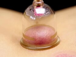 Chinese Cupping Stock Footage