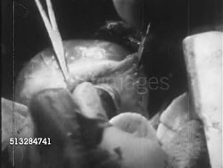 1960s: HEART SURGERY: VS Doctors, heart surgeons, surrounding patient in surgery, SEMI-GRAPHIC installing artificial heart into patient, pumps pumping artificial heart, thumping. Cardiovascular surgery, cardiac, Michael E. DeBakey, health, medicine Instructional Video
