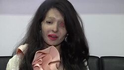 VOICED : Modelo desfigurada por acido inaugura Fashion Week en Nueva York News Clip