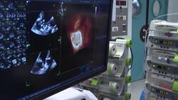 CLEAN : New 3D probe allows French doctors to better care for children with heart defects News Clip