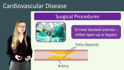 Treating Cardiovascular Disease: Medications, Surgery, and Lifestyle Changes Instructional Video