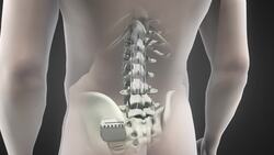 Revolutionary spine implants let paraplegics walk again Instructional Video