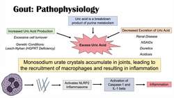 Gout | Causes, Pathophysiology, Risk Factors (ex. Diet), Symptoms, Diagnosis, Treatment Instructional Video