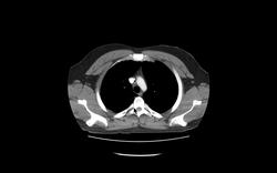 Anatomy of CT scans: Thoracic cavity Instructional Video