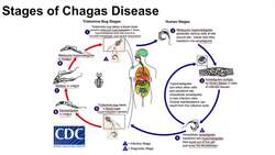 Chagas Disease | American Trypanosomiasis | Causes, Symptoms and Treatment Instructional Video