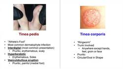 Overview of Fungal Skin Infections | Tinea Infections Instructional Video