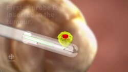 Carling Muir's Brain Cancer Procedure News Clip