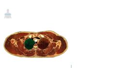 3rd Thoracic Vertebra Level Instructional Video