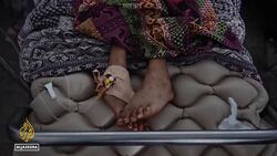 Gaza hospitals overwhelmed as malnutrition crisis worsens News Clip