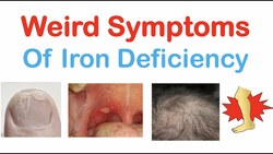 Weird Symptoms of Iron Deficiency | Nails, Tongue, Skin, Hair & Others Instructional Video